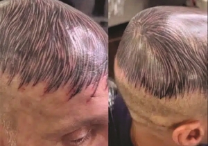 HOMEM TATUA FIOS DE CABELO NA CABEÇA E VIRALIZA NA INTERNET